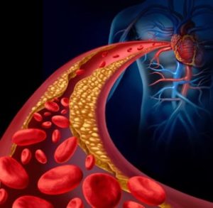 animation of plaque buildup in the bloodstream