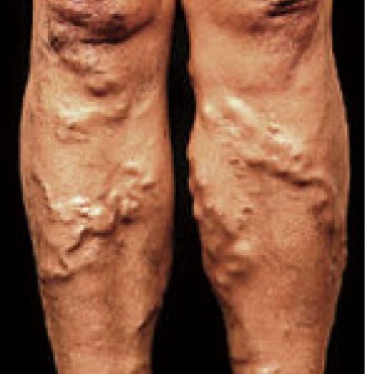 image of varicose veins