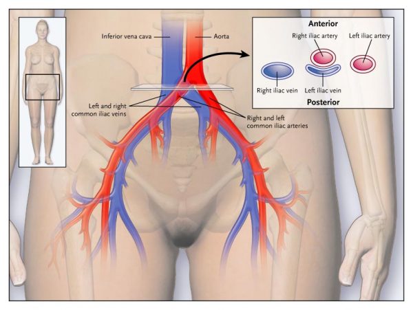 illustration of iliac venous stenting