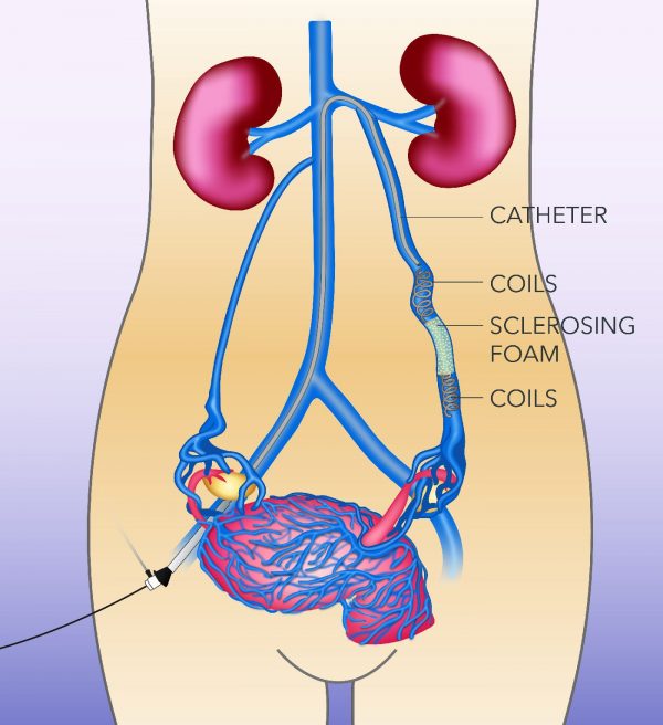 ovarian vein embolization