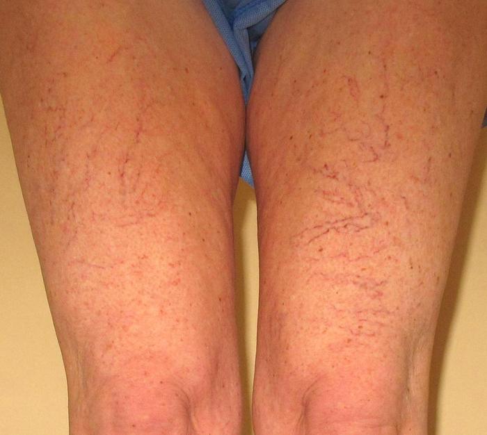 image of spider veins