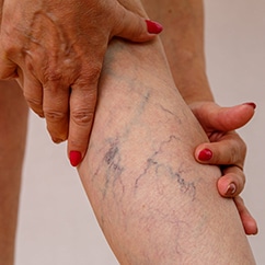 A closeup image of an elderly woman holding her calf and examining spider and varicose veins.